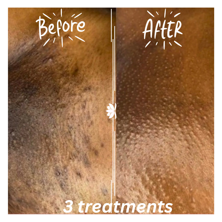 BioRePeelCl3® with Restore & Protect | Step 2 & Step 5